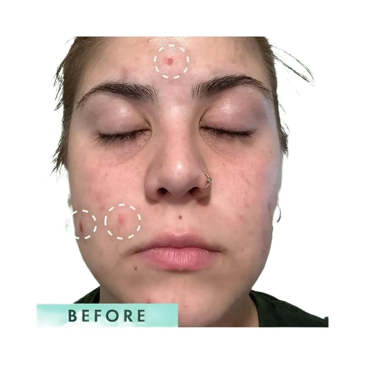 Rael Miracle Clear Complete Acne Serum