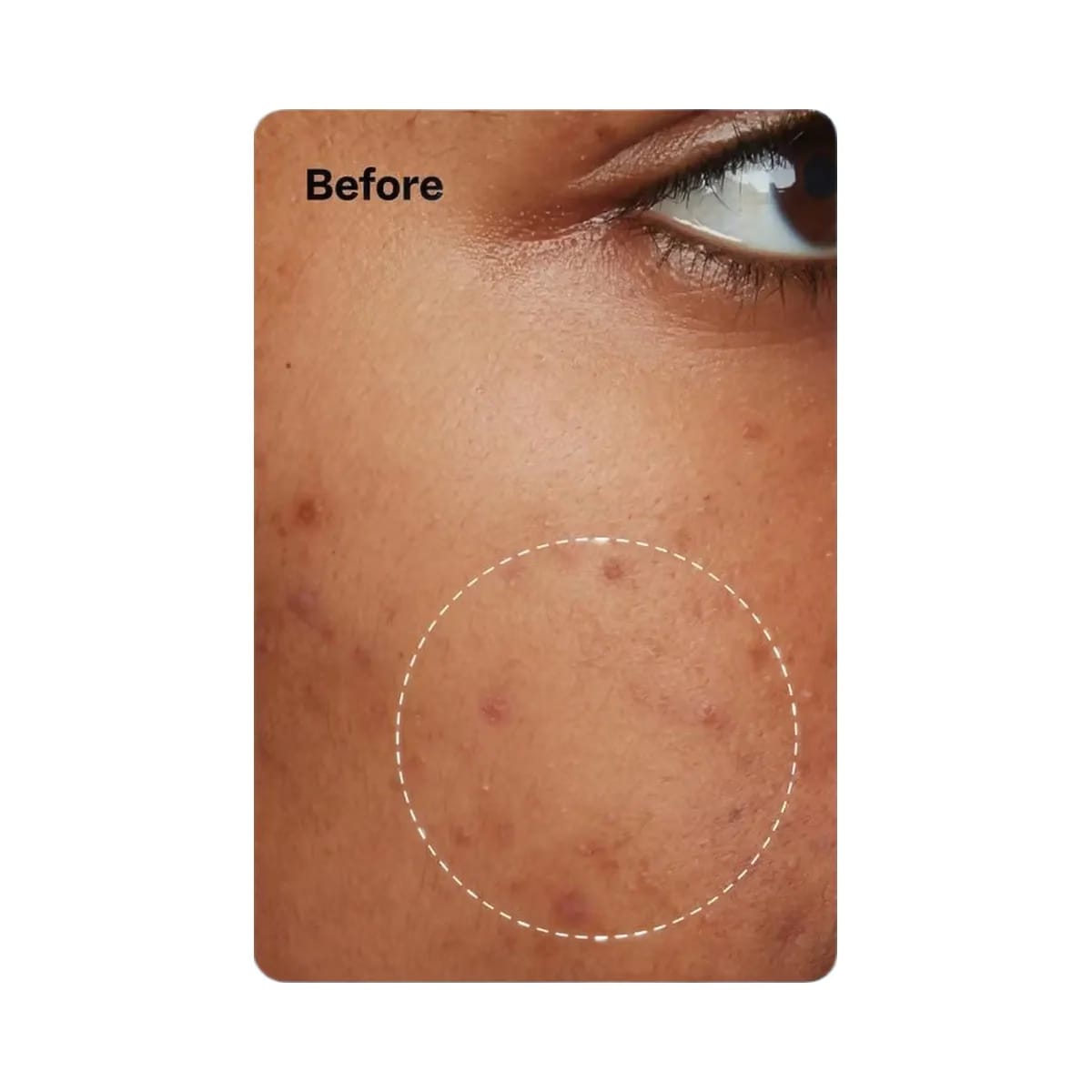 Peach Slices Acne Oil-Free Moisturizer