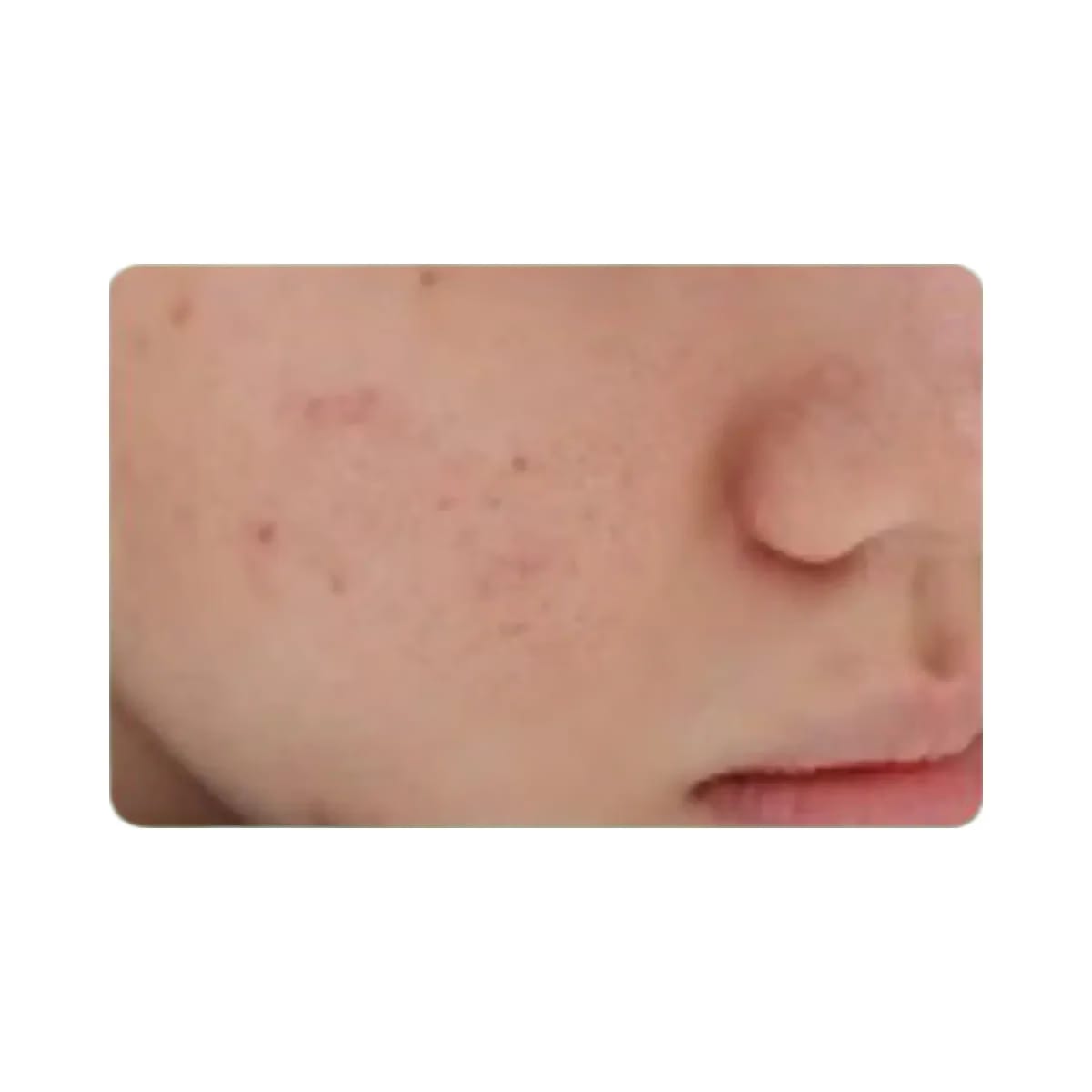 MEDIHEAL Teatree Calming Hydra Serum