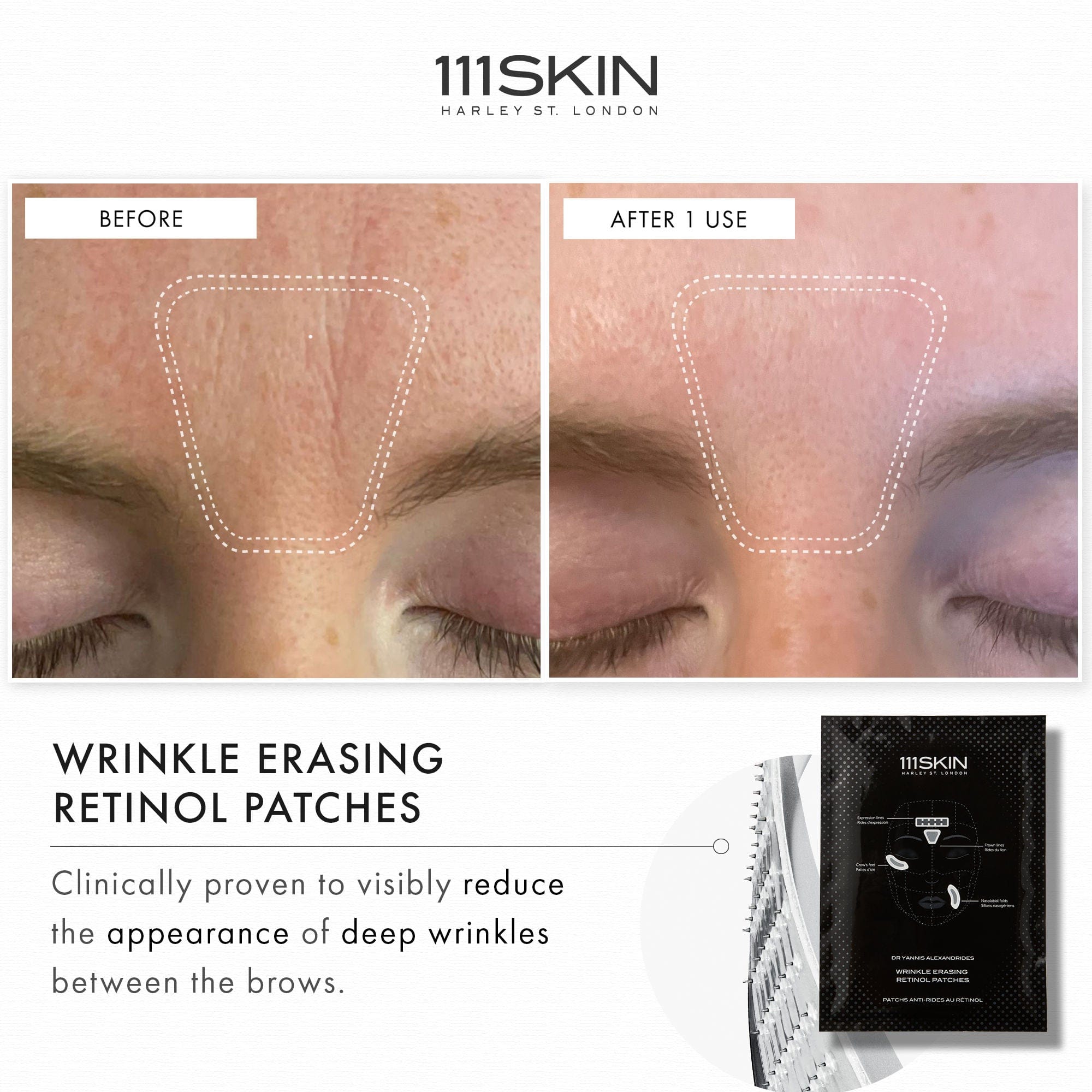 111skin Wrinkle Erasing Retinol Patches