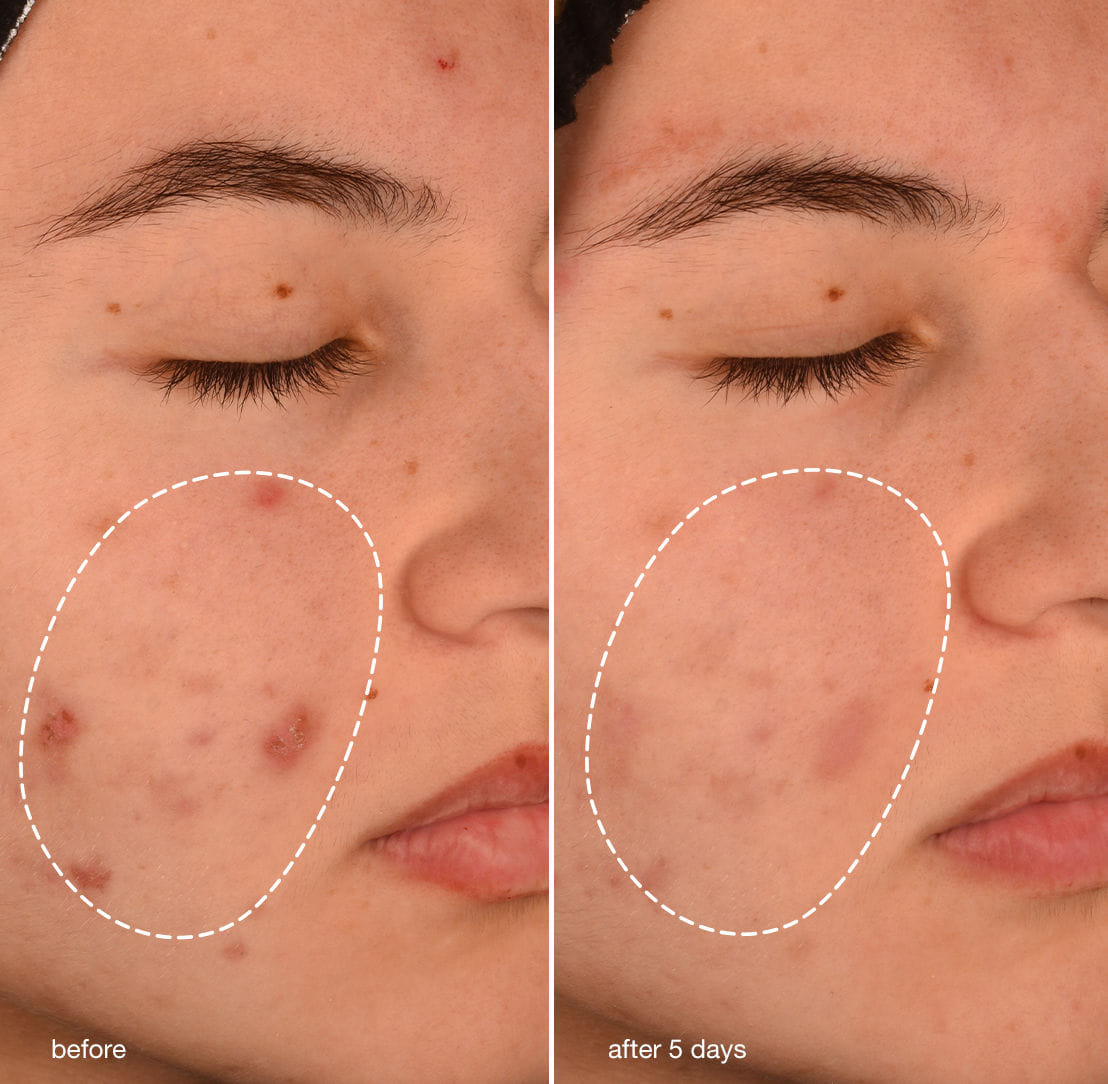 Dermalogica Acne Biotic Moisturizer