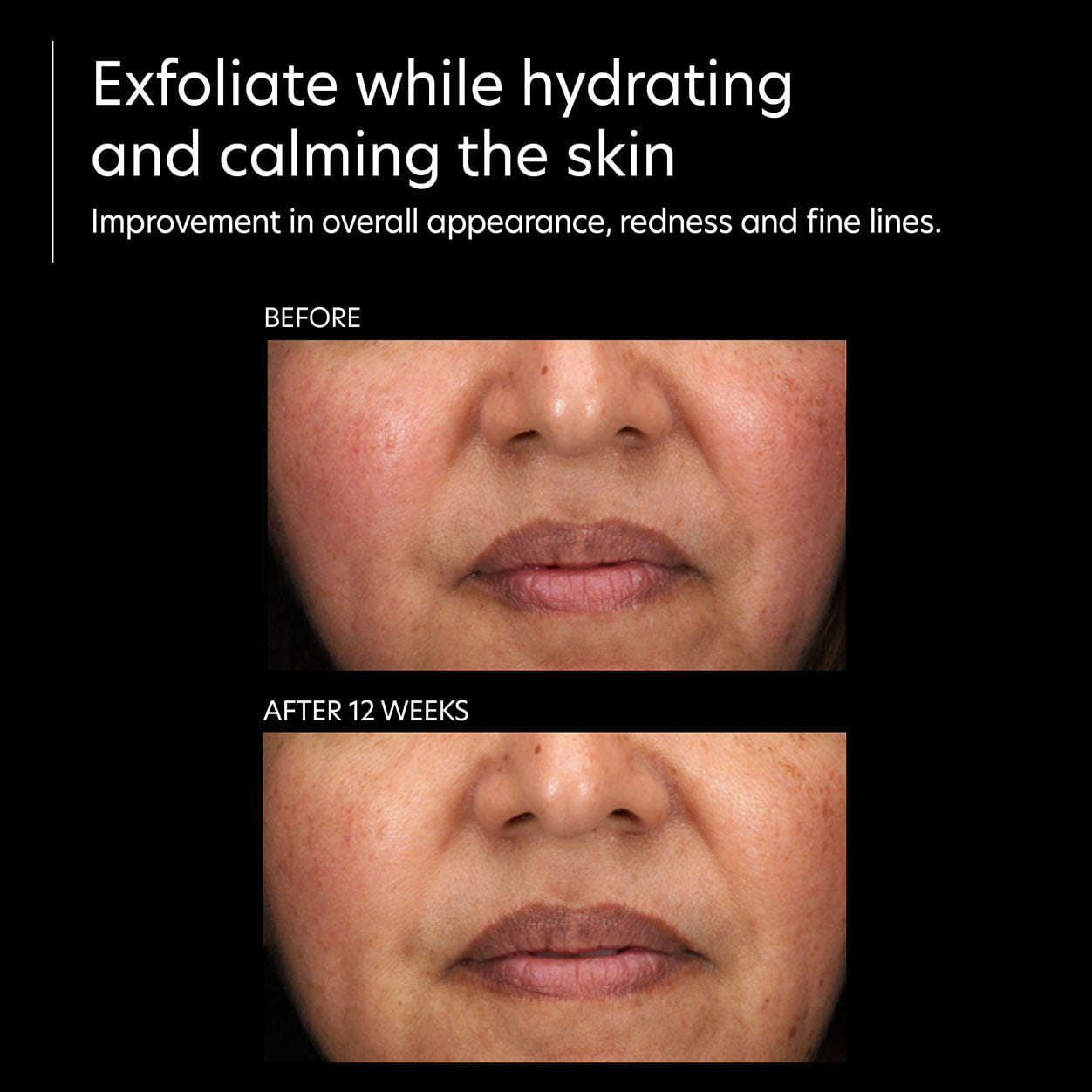 PCA Skin Resurfacing Serum